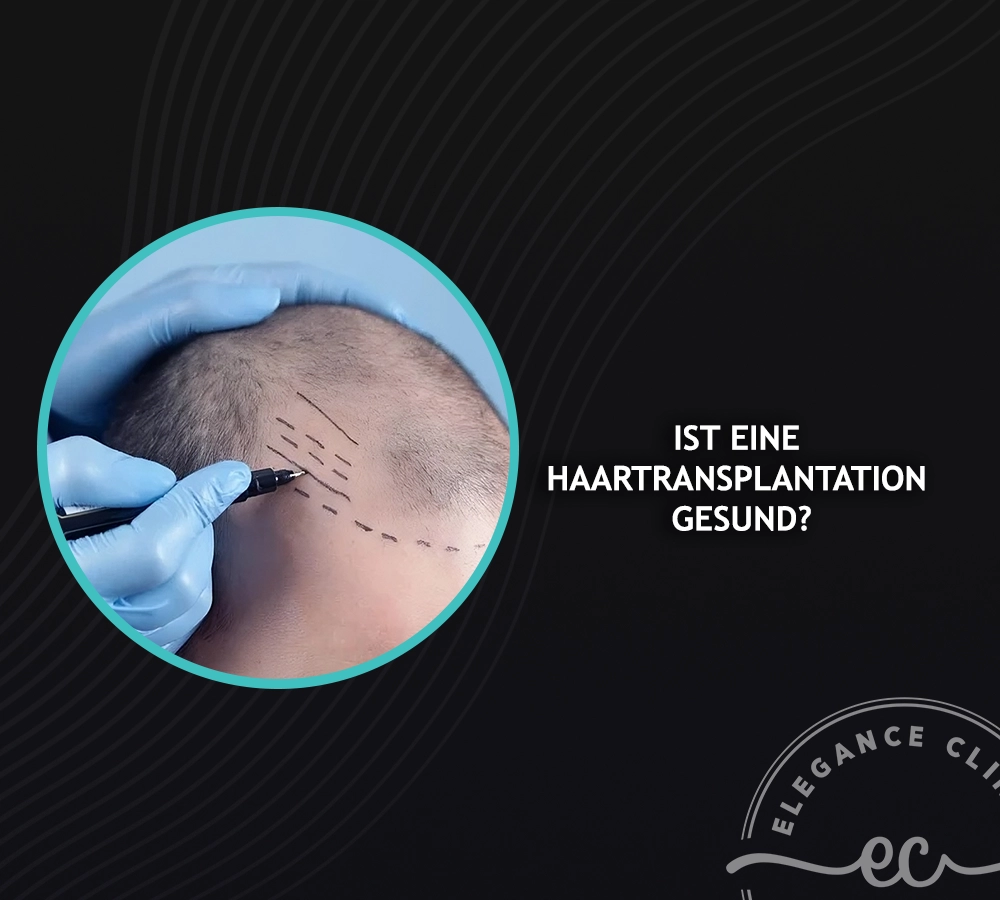 Ist eine Haartransplantation gesund? -Leitfaden für die richtige Entscheidung