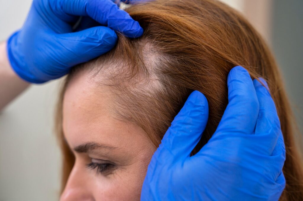 Hair Transplant for Females