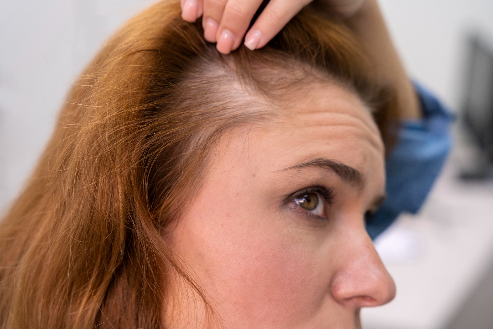 Hair Transplant for Females: How is it Done? What are the Advantages?