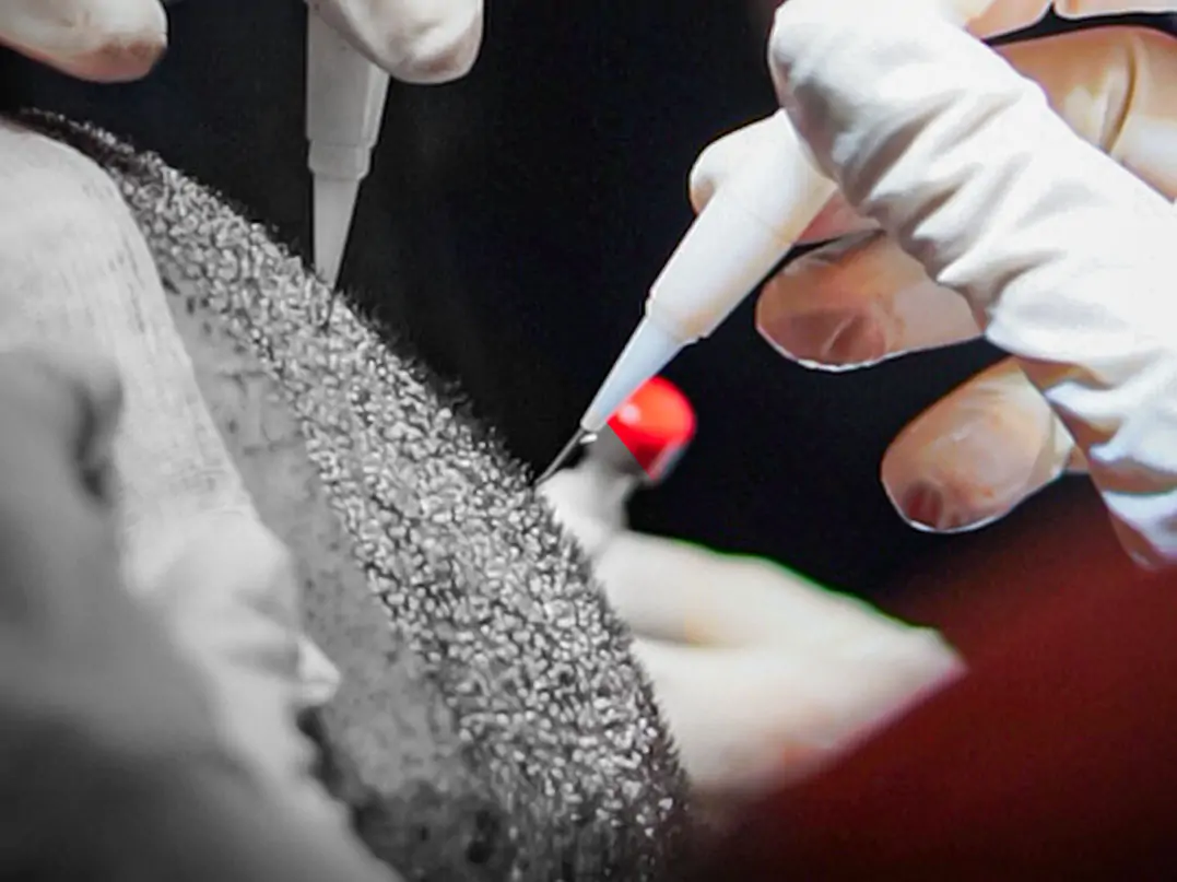 Trapianto di Capelli DHI