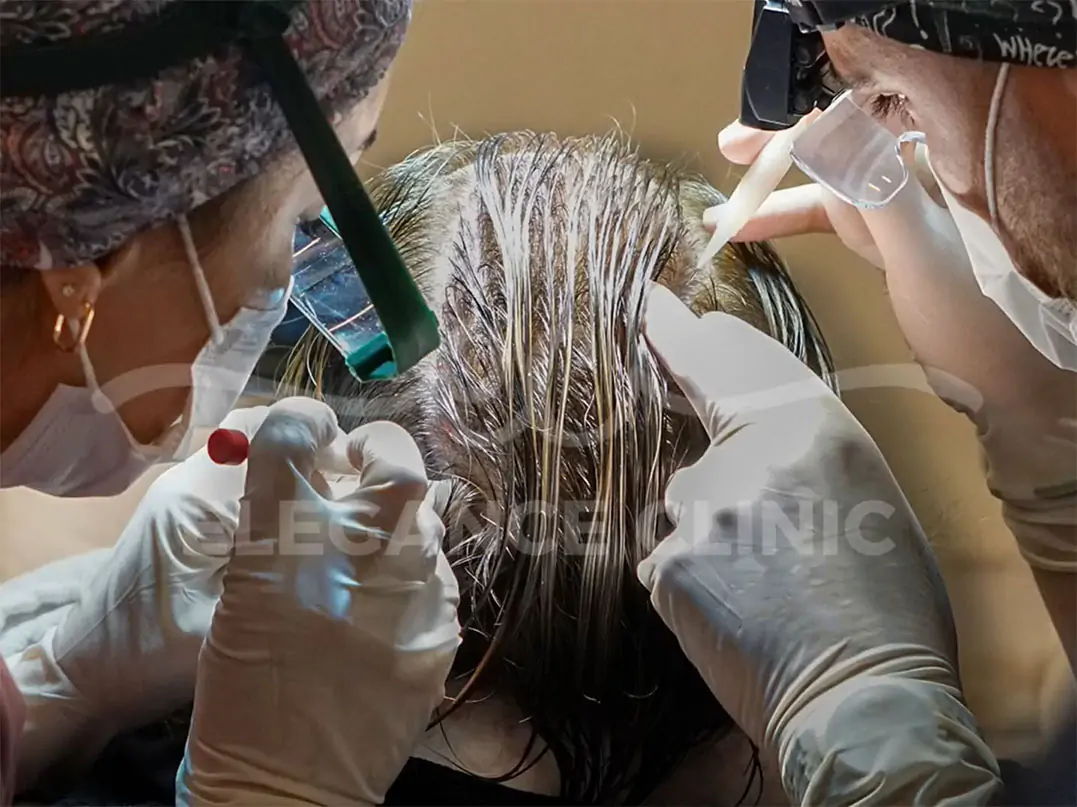 Trapianto di Capelli per Donne