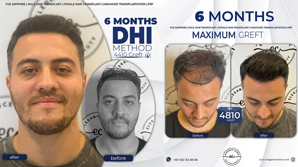 Saç ekimi ne zaman etkisini gösterir?