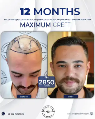 sac_ekimi_oncesivesonrasi_1