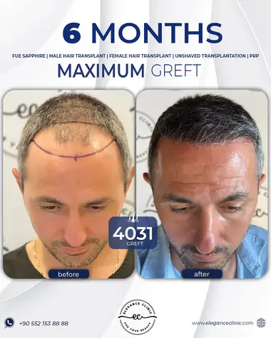 sac_ekimi_oncesivesonrasi_10