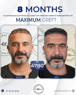 sac_ekimi_oncesivesonrasi_12