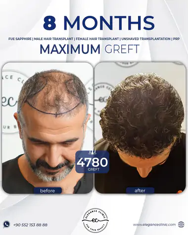 sac_ekimi_oncesivesonrasi_13