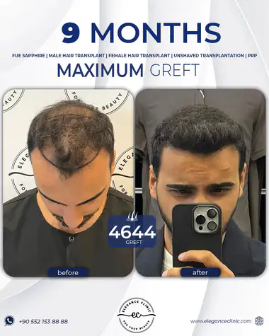 sac_ekimi_oncesivesonrasi_14