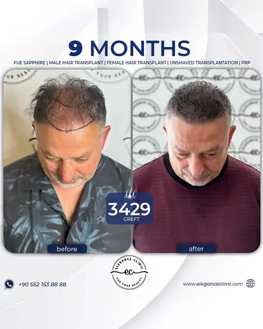 sac_ekimi_oncesivesonrasi_15