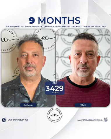 sac_ekimi_oncesivesonrasi_16