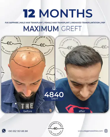 sac_ekimi_oncesivesonrasi_17