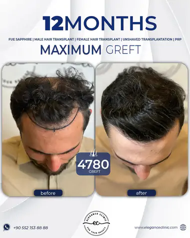 sac_ekimi_oncesivesonrasi_18