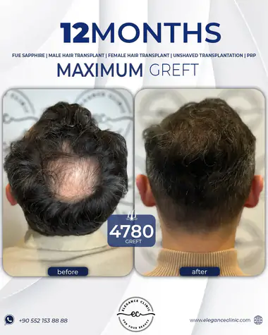 sac_ekimi_oncesivesonrasi_19