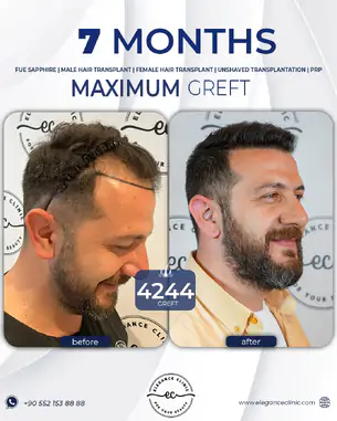 sac_ekimi_oncesivesonrasi_2