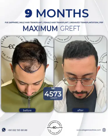 sac_ekimi_oncesivesonrasi_20