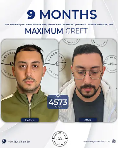 sac_ekimi_oncesivesonrasi_21