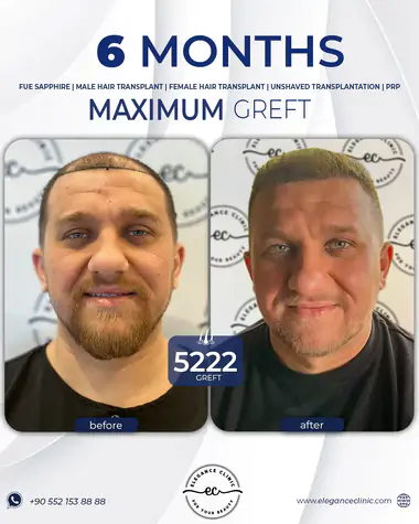 sac_ekimi_oncesivesonrasi_23