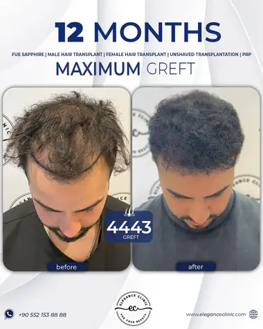 sac_ekimi_oncesivesonrasi_24