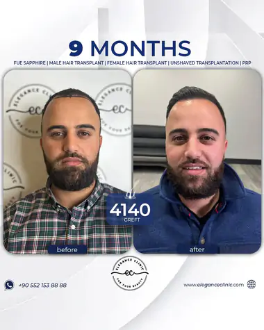 sac_ekimi_oncesivesonrasi_25