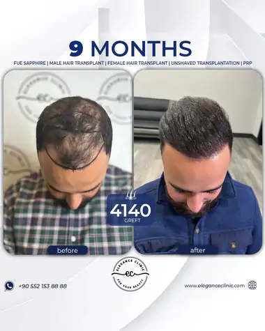 sac_ekimi_oncesivesonrasi_26