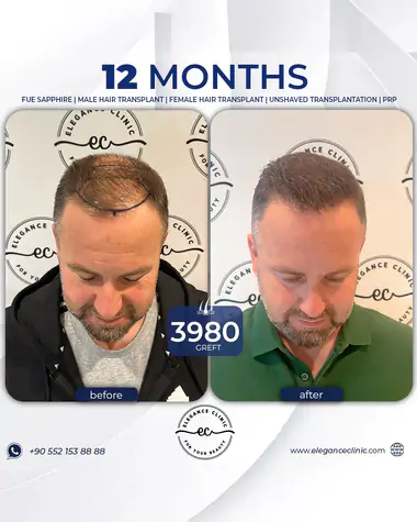 sac_ekimi_oncesivesonrasi_28