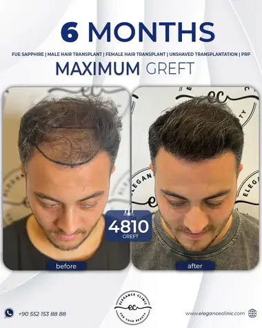 sac_ekimi_oncesivesonrasi_29