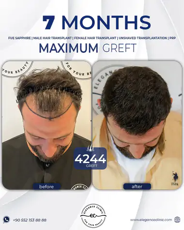 sac_ekimi_oncesivesonrasi_3