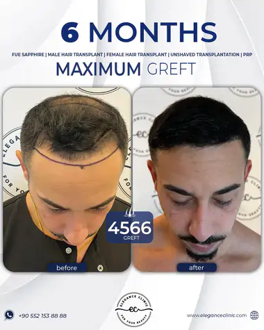 sac_ekimi_oncesivesonrasi_30