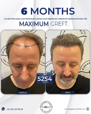 sac_ekimi_oncesivesonrasi_4