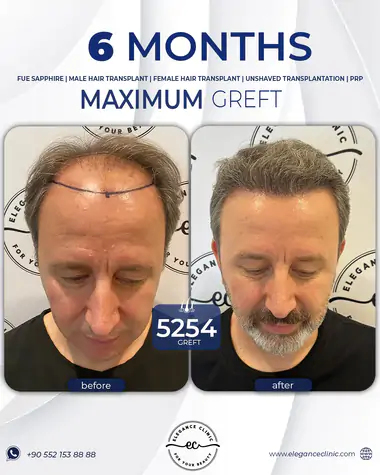 sac_ekimi_oncesivesonrasi_4