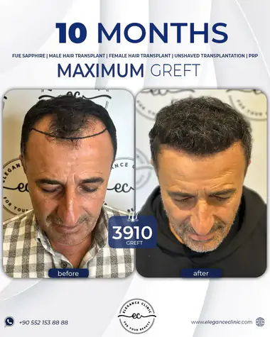 sac_ekimi_oncesivesonrasi_5