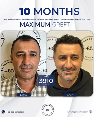 sac_ekimi_oncesivesonrasi_6