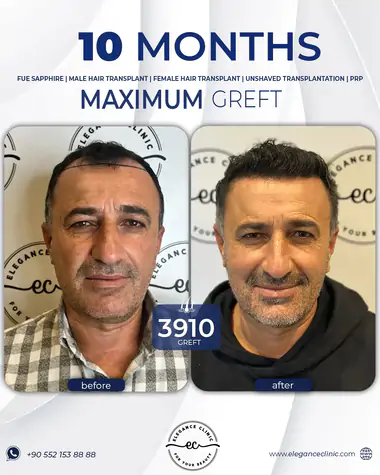 sac_ekimi_oncesivesonrasi_6