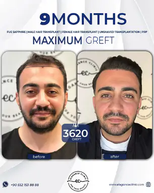 sac_ekimi_oncesivesonrasi_7