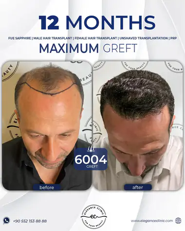 sac_ekimi_oncesivesonrasi_8