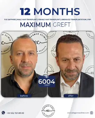 sac_ekimi_oncesivesonrasi_9