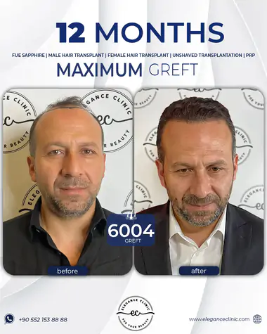 sac_ekimi_oncesivesonrasi_9