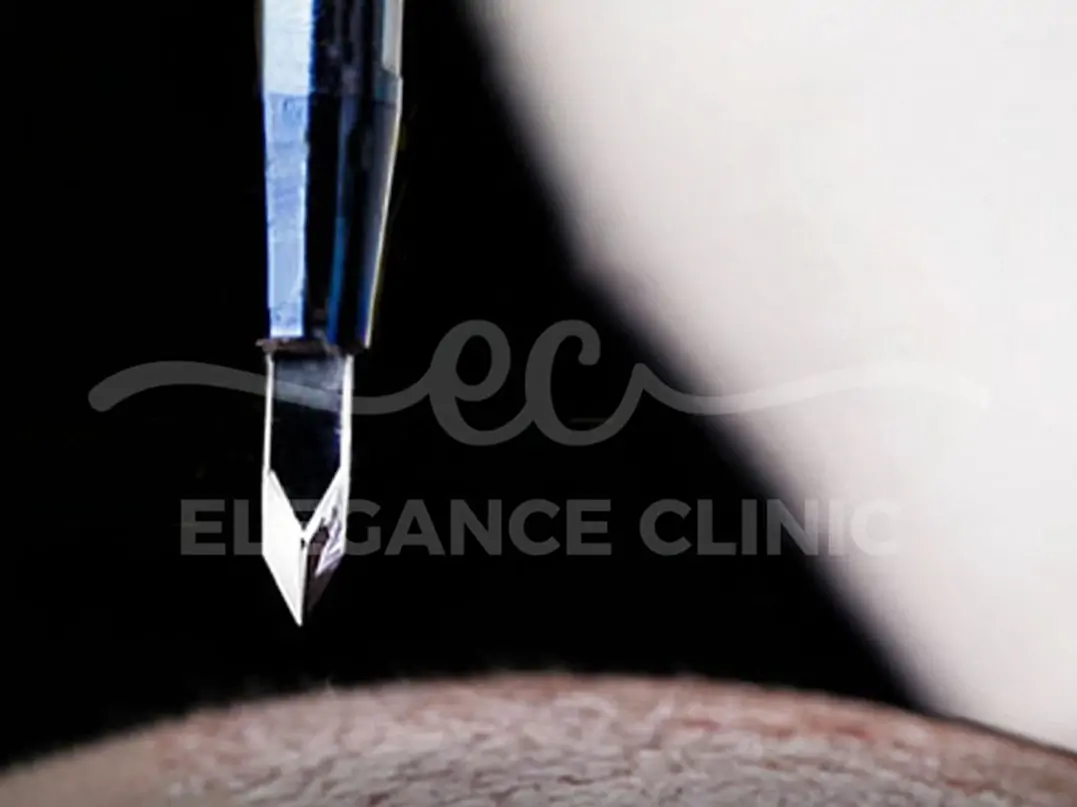 Trapianto di Capelli FUE con Zaffiro