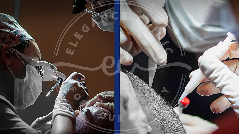 Trapianto di Capelli DHI