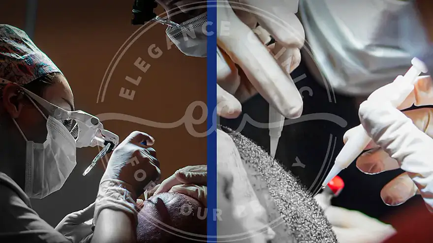 Métodos de Trasplante Capilar: Diferencias entre FUE y DHI