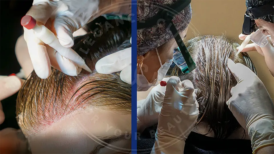 Trapianto di capelli per donne