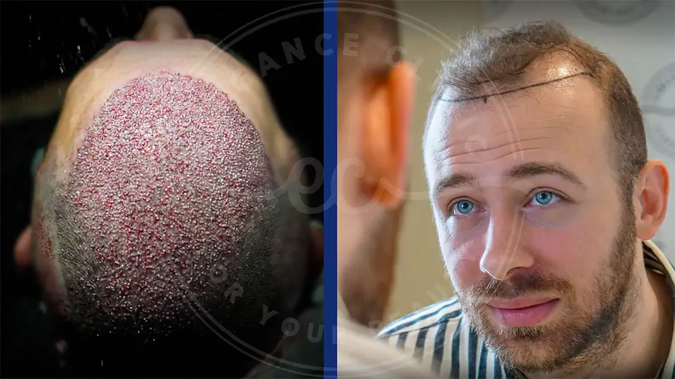Hair Transplant