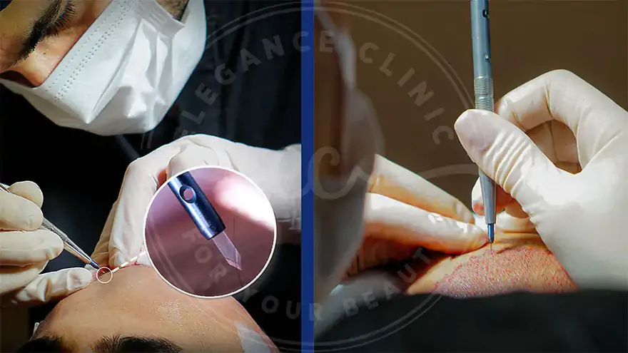 Saç Ekiminde Kanal Açılması Nedir? Neden Önemlidir?