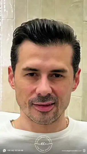 Öncesi–sonrası kısa video 7