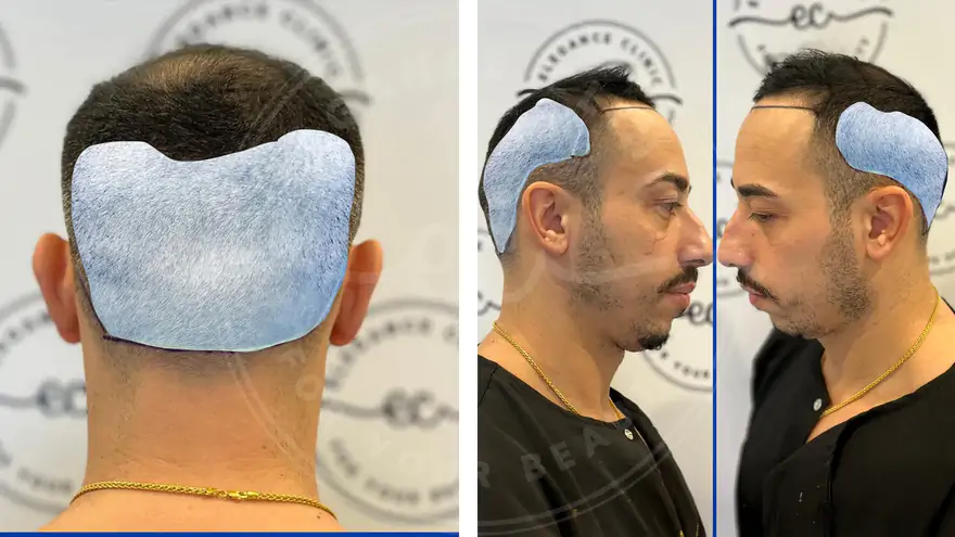 Saç Ekimi Sonrası Kabuklanma Ne Zaman Dökülür?