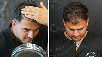 Terlemek Saç Ekimine Zarar Verir Mi?