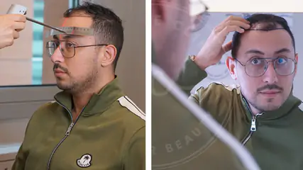 Saç Ekimi Sonrası Kaşıntı Neden Olur? Ne Zaman Geçer?