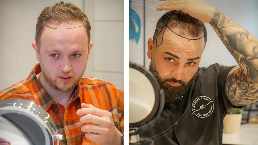 زراعة الشعر: لماذا يحدث تساقط الصدمة؟ ومتى ينتهي؟