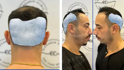 Saç Ekimi Sonrası Ense Bölgesi Ne Zaman İyileşir?