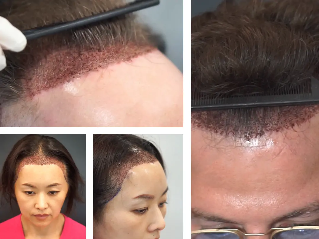 Tıraşsız Saç Ekimi