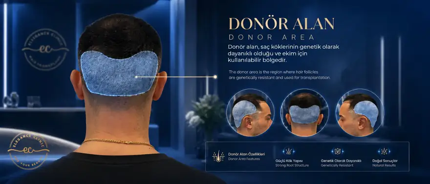 Saç Ekiminde Donör Bölge Nedir? Doğru Planlama Rehberi